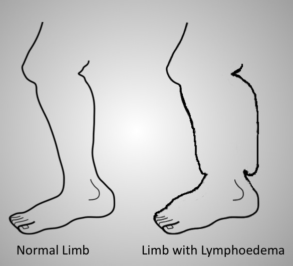 Lymphoedema leg