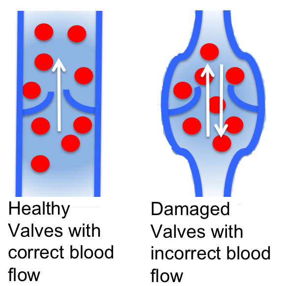 normal and distended valves